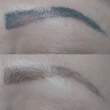 Удаление татуажа